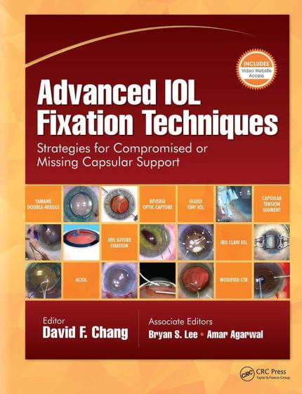 Advanced IOL Fixation Techniques: Strategies for Compromised or Missing Capsular Support (PDF + Videos)