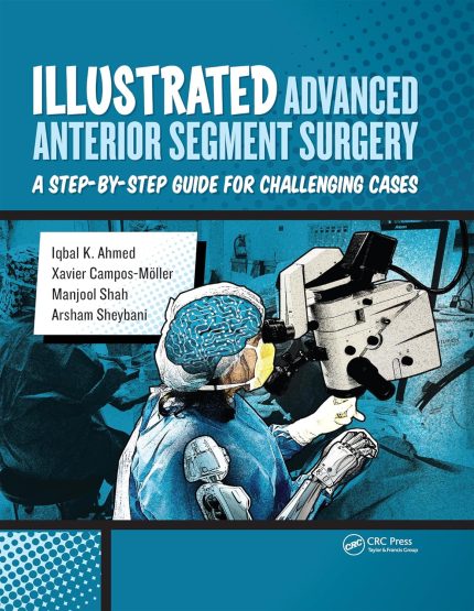 Illustrated Advanced Anterior Segment Surgery: A Step-by-Step Guide for Challenging Cases (1st Edition)